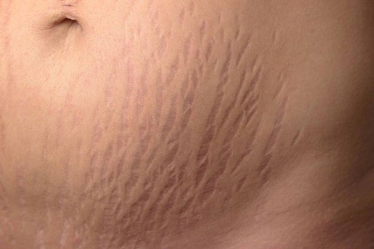 ترک های پوستی یا استرچ مارک