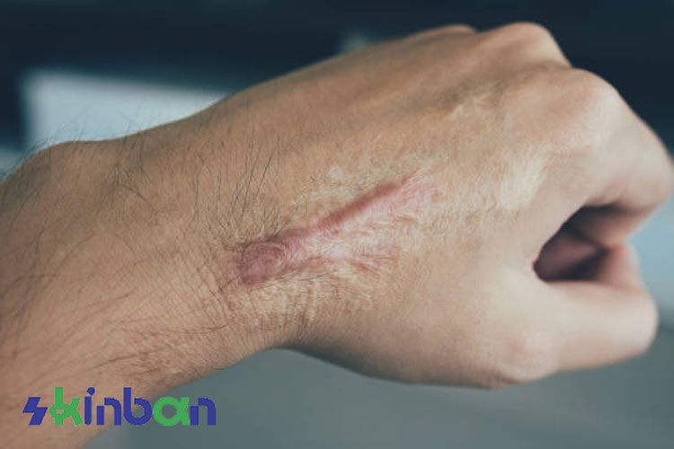 هیپرتروفیک اسکار