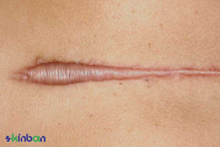 اسکار کلوئیدی