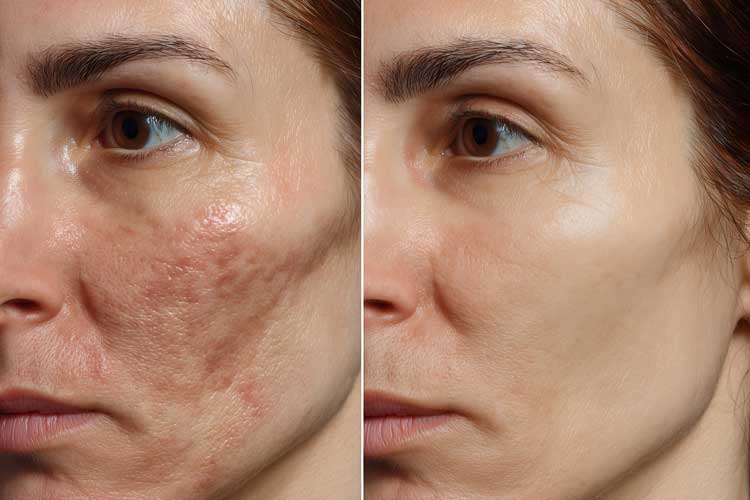 درمان جای زخم بدون لیزر