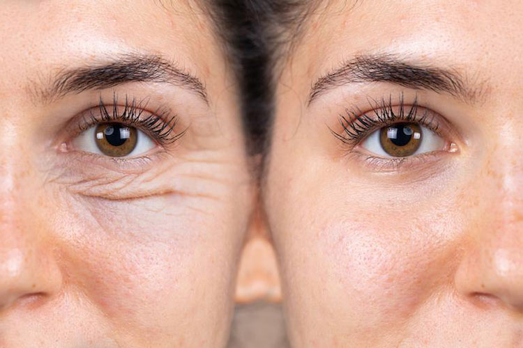 تفاوت هایفو و لیز پوست