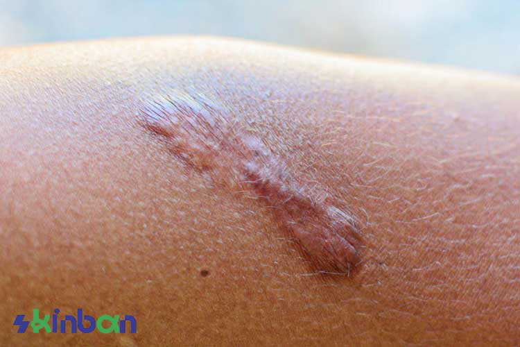 روش های درمان زخم برجسته