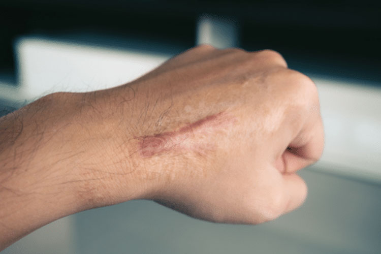 درمان زخم های برجسته