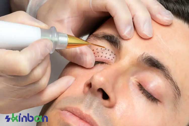 کاربردهای پلاسما جت