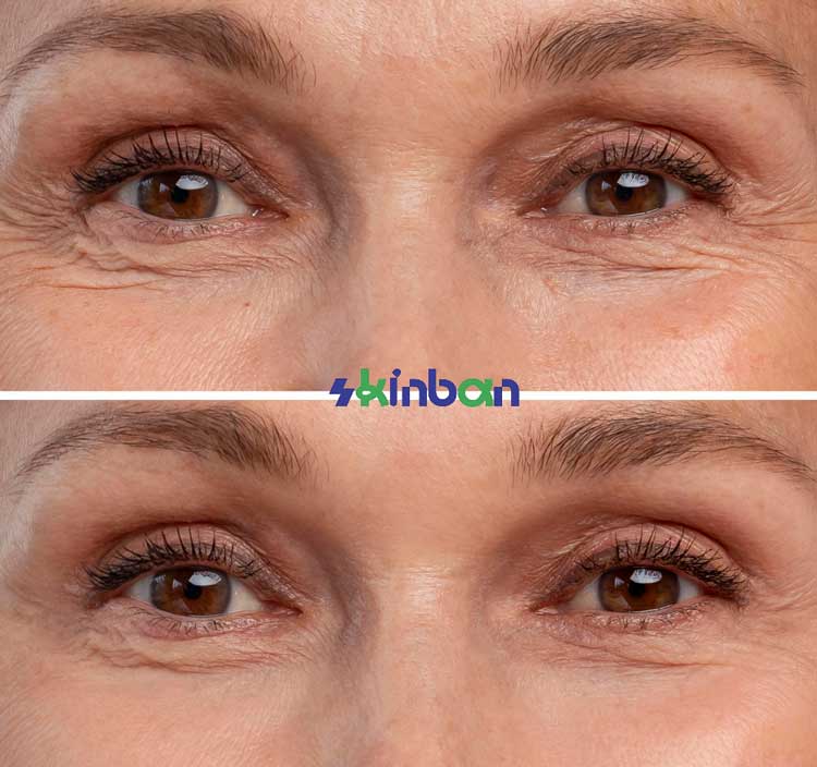 رفع چین و چروک دور چشم