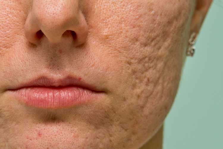 جای زخم فرو رفته