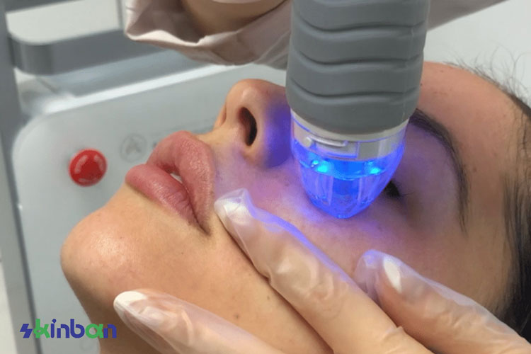 مزایای فرکشنال