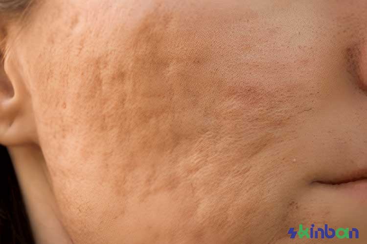 درمان جای زخم فرو رفته