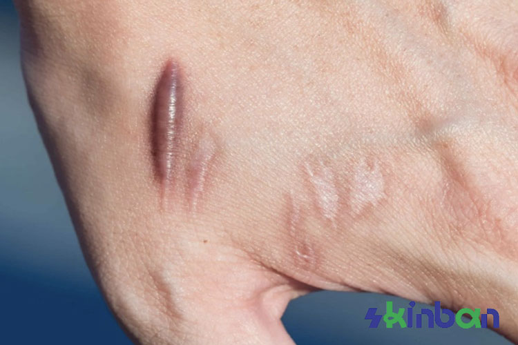 درمان اسکار ها وزخم های کلوئیدی