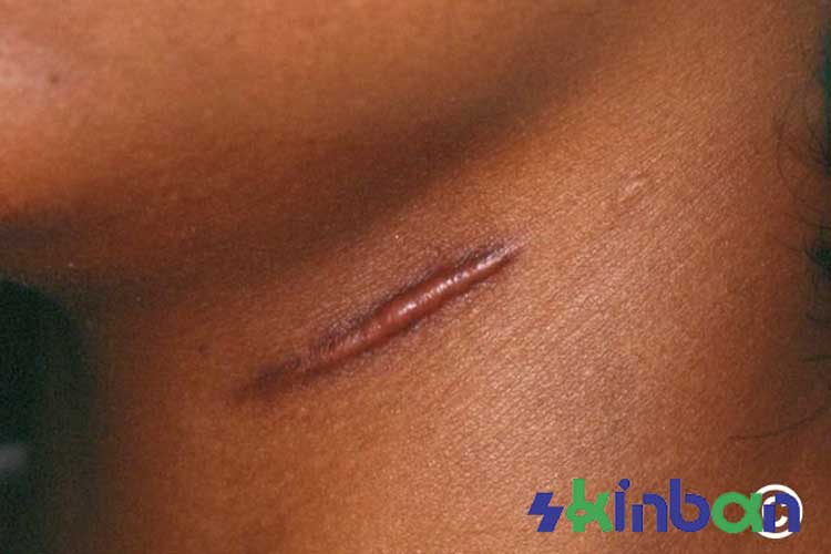 اسکارهای کلوئیدی