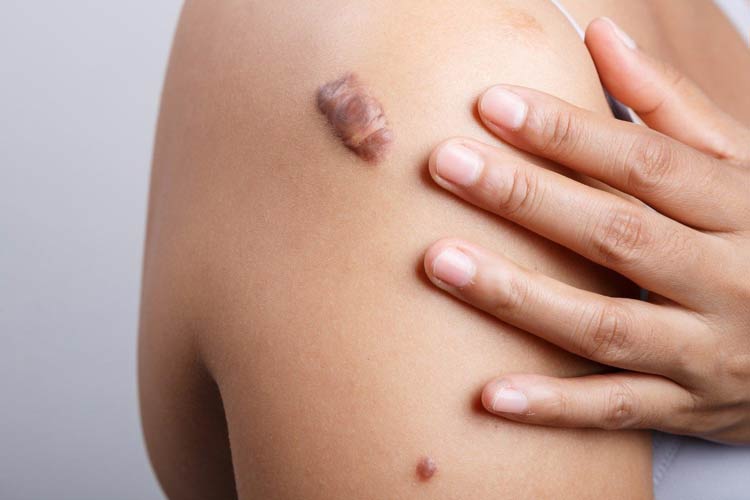 اسکارهای کلوئیدی