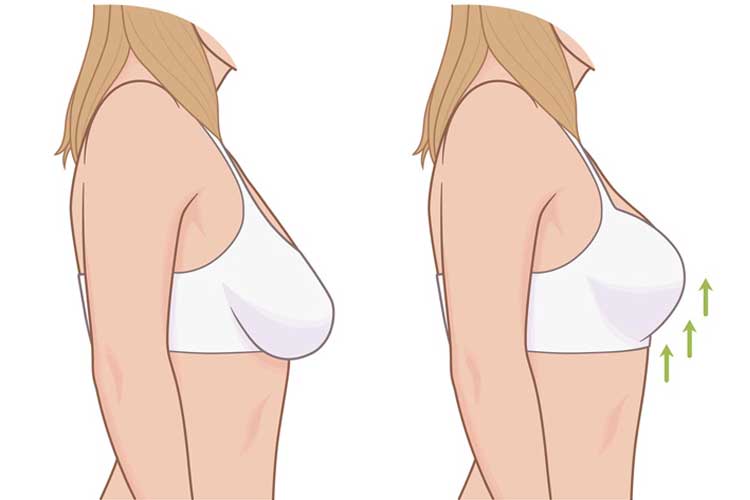 لیفت سینه به روش جراحی